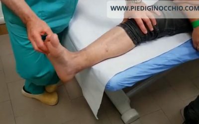 Protesi di caviglia dopo un anno dall’intervento